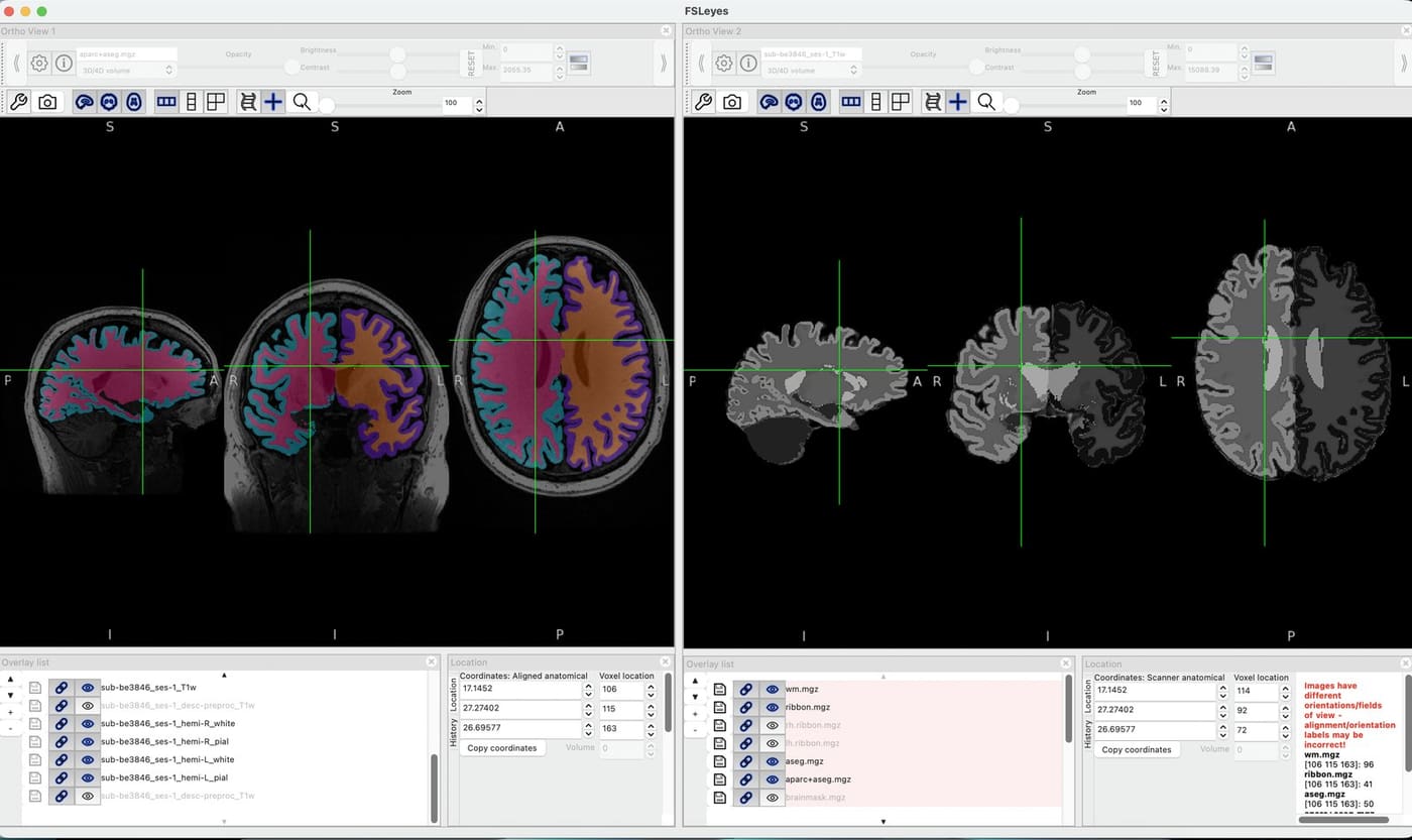 Fig. 2 — One scan after FreeSurfer, seen in FSLeyes. The cortical ribbon and subcortical structures have been segmented from the raw T1 scan, shown in color at left and as a grayscale label map at right. This anatomy is the coordinate frame every functional measurement is read against.